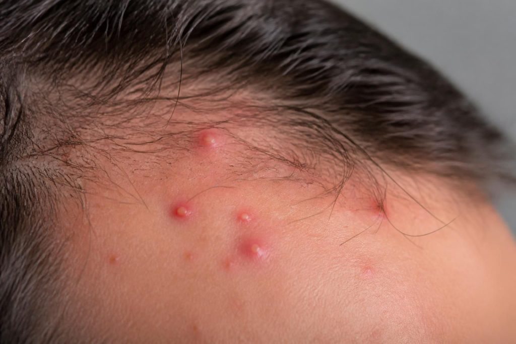 Acne cuir chevelu : identifier et traiter les boutons sur la tête